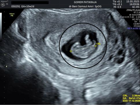 Visualisasi Janin Lewat USG Minggu ke-10: Posisi & Aktivitas Bayi