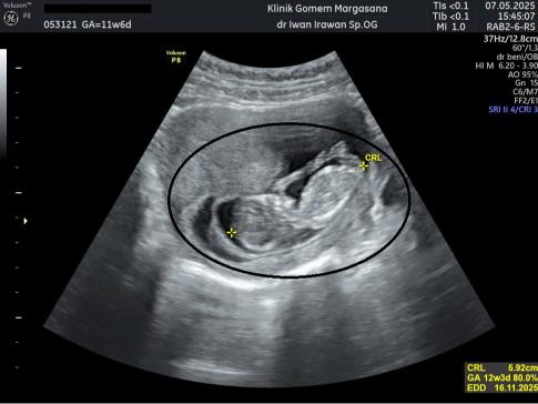 Gambaran Hasil USG Janin 11 Minggu Gambaran Hasil USG Janin 11 Minggu