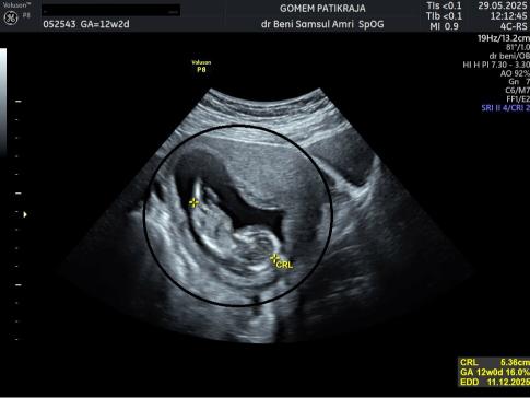 Dokumentasi USG Janin 12 Minggu Lengkap: Posisi & Aktivitas Bayi