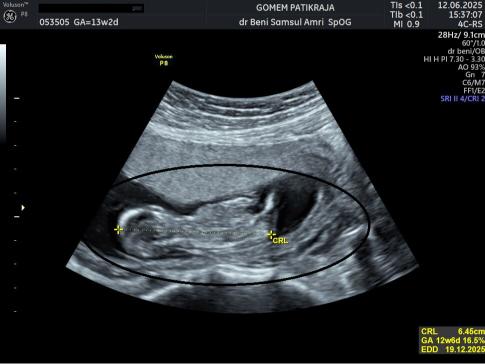 Gambaran Hasil USG Janin 13 Minggu: Posisi, Gerakan & Organ Vital