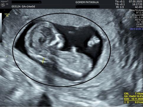 Gambaran Hasil USG Janin 14 Minggu: Posisi, Gerakan & Organ Vital