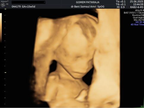 Gambaran Hasil USG Janin 15 Minggu