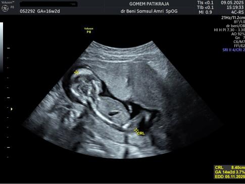 Visualisasi Janin Lewat USG Minggu ke-16: Posisi & Aktivitas Bayi