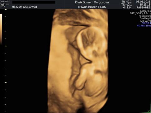 Hasil Pemeriksaan USG Janin 17 Minggu: Panduan Lengkap Bumil