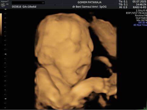 Gambaran Hasil USG Janin 18 Minggu