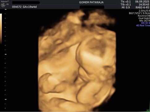 Gambaran Hasil USG Janin 19 Minggu