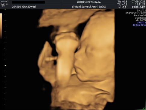 Gambaran Hasil USG Janin 20 Minggu