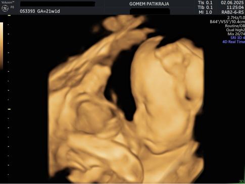 Gambaran Hasil USG Janin 21 Minggu