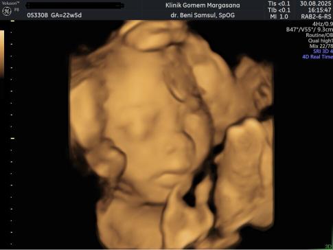 Dokumentasi USG Janin 22 Minggu Lengkap: Posisi & Aktivitas Bayi