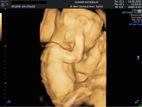 Gambaran Hasil USG Janin 23 Minggu Gambaran Hasil USG Janin 23 Minggu