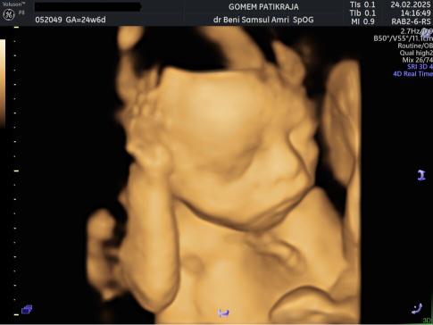 Visualisasi Janin Lewat USG Minggu ke-24: Posisi & Aktivitas Bayi