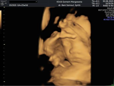 Gambaran Hasil USG Janin 25 Minggu: Posisi, Gerakan & Organ Vital Gambaran Hasil USG Janin 25 Minggu: Posisi, Gerakan & Organ Vital