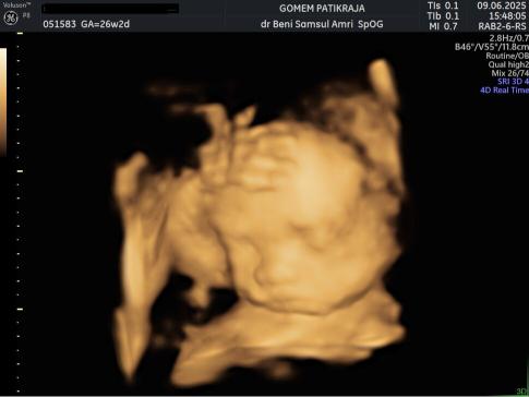 Gambaran Hasil USG Janin 26 Minggu Gambaran Hasil USG Janin 26 Minggu