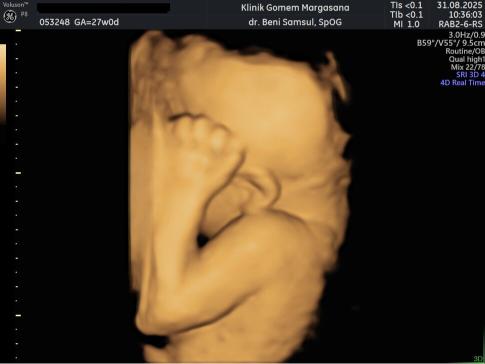 Gambaran Hasil USG Janin 27 Minggu