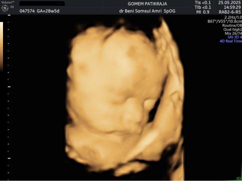 Contoh Hasil USG 4 Dimensi Janin 7 Bulan