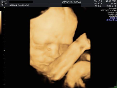Gambaran Hasil USG Janin 29 Minggu Gambaran Hasil USG Janin 29 Minggu