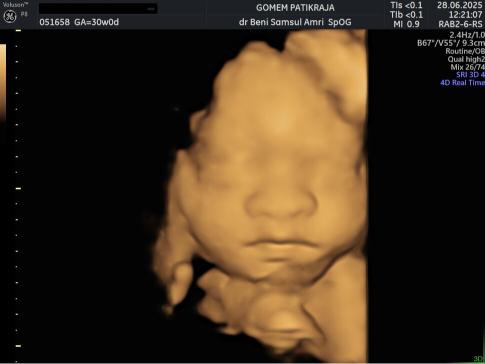 Gambaran Hasil USG Janin 30 Minggu Gambaran Hasil USG Janin 30 Minggu