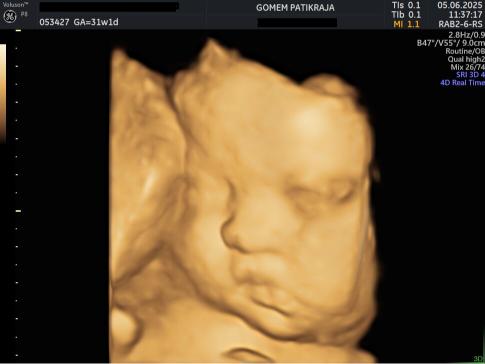 Gambaran Hasil USG Janin 31 Minggu