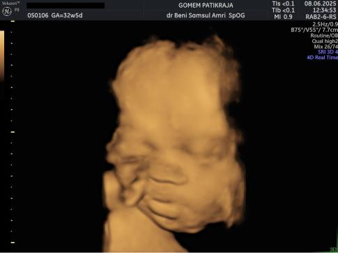 Penampakan Bayi di Rahim USG 32 Minggu: Berat, Panjang & Organ