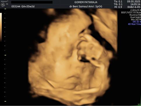 Hasil Pemeriksaan USG Janin 33 Minggu: Panduan Lengkap Bumil Hasil Pemeriksaan USG Janin 33 Minggu: Panduan Lengkap Bumil