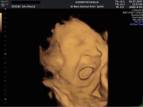 Gambaran Hasil USG Janin 34 Minggu Gambaran Hasil USG Janin 34 Minggu