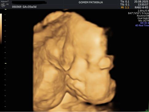 Hasil Scan USG Janin 35 Minggu: Berat, Panjang & Organ Vital Hasil Scan USG Janin 35 Minggu: Berat, Panjang & Organ Vital