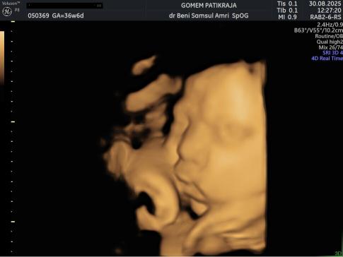 Foto USG Kehamilan 36 Minggu: Berat, Panjang & Pertumbuhan Bayi