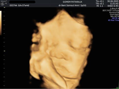 Gambaran Hasil USG Janin 37 Minggu