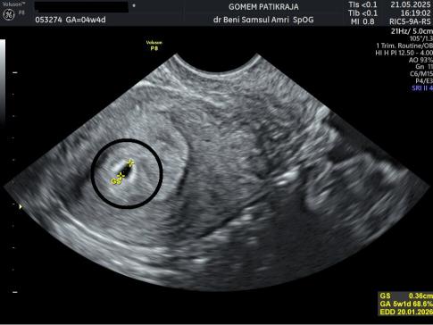 Gambaran Hasil USG Janin 4 Minggu Gambaran Hasil USG Janin 4 Minggu