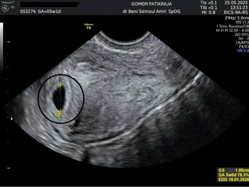Foto USG Kehamilan 5 Minggu: Berat, Panjang & Pertumbuhan Bayi