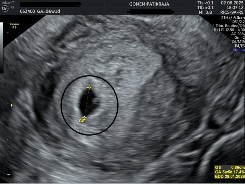 Hasil Scan USG Janin 6 Minggu: Berat, Panjang & Organ Vital Hasil Scan USG Janin 6 Minggu: Berat, Panjang & Organ Vital