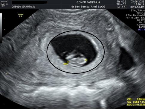 Gambaran Hasil USG Janin 7 Minggu