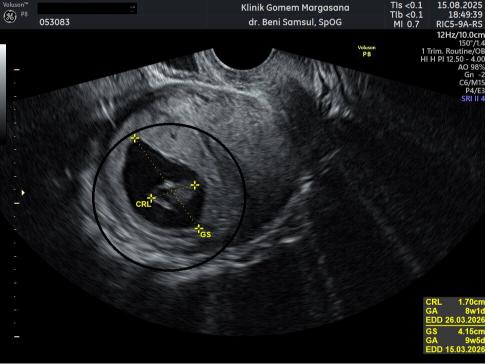 Detail Janin Saat USG 8 Minggu: Organ Vital, Gerakan & Posisi