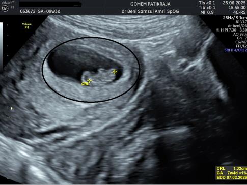 Membaca Hasil USG Janin Usia 9 Minggu Secara Medis